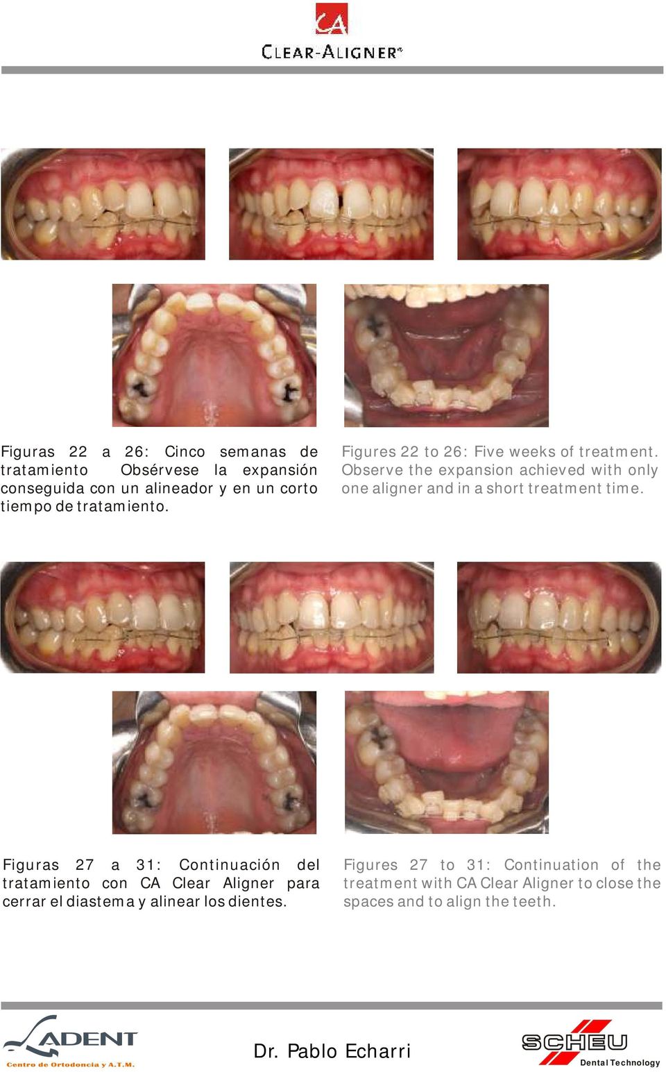 Observe the expansion achieved with only one aligner and in a short treatment time.