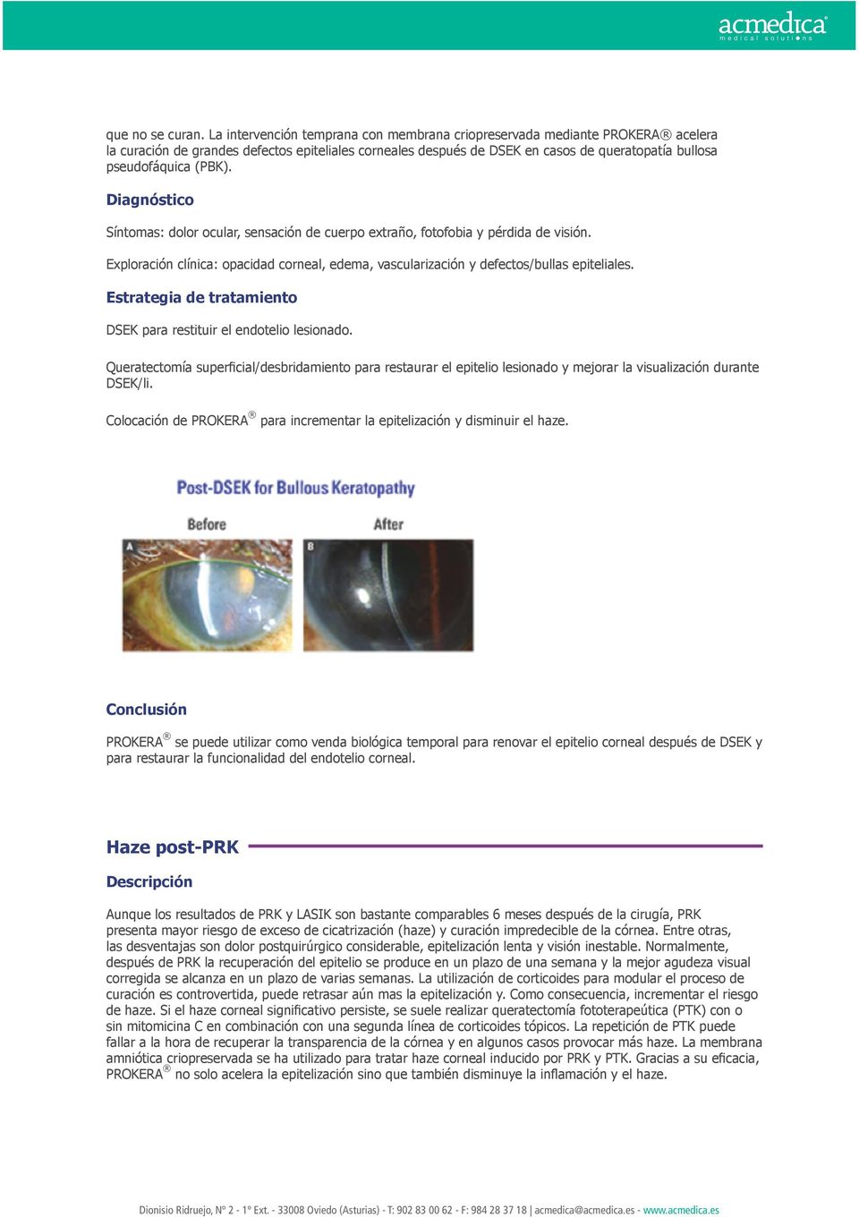 (PBK). Diagnóstico Síntomas: dolor ocular, sensación de cuerpo extraño, fotofobia y pérdida de visión. Exploración clínica: opacidad corneal, edema, vascularización y defectos/bullas epiteliales.
