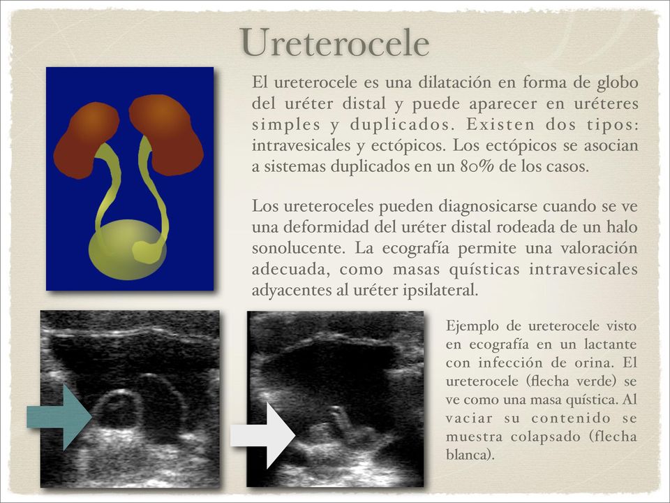 Los ureteroceles pueden diagnosicarse cuando se ve una deformidad del uréter distal rodeada de un halo sonolucente.