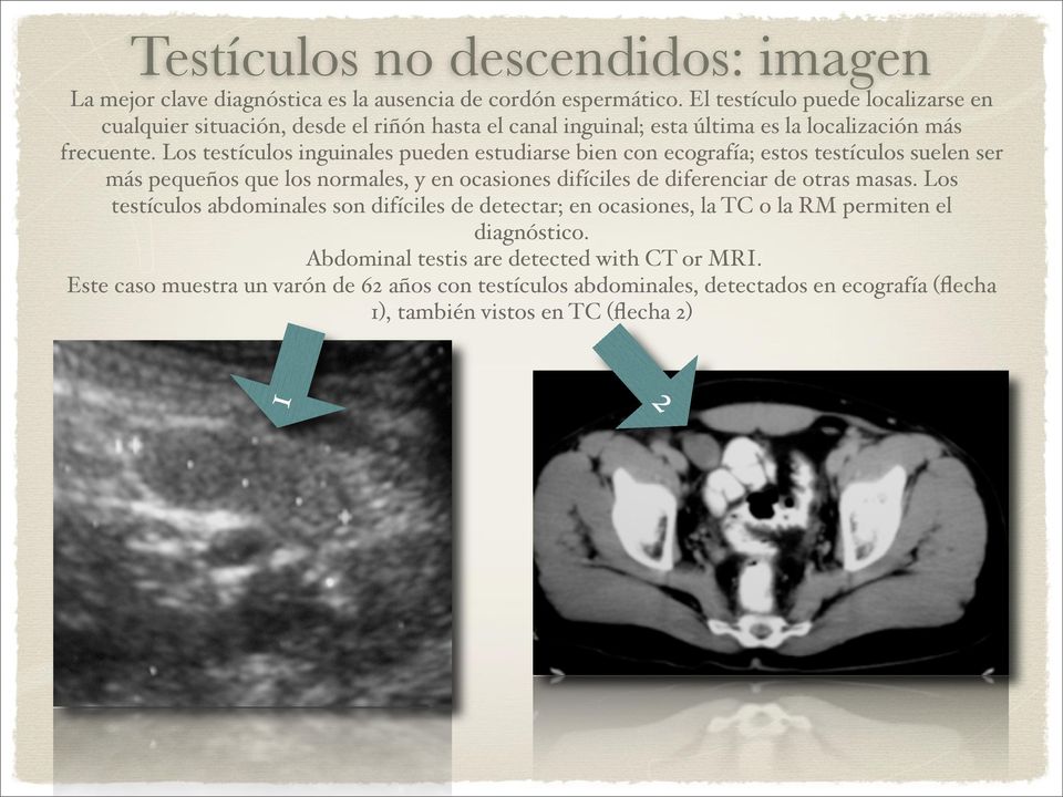 Los testículos inguinales pueden estudiarse bien con ecografía; estos testículos suelen ser más pequeños que los normales, y en ocasiones difíciles de diferenciar de otras masas.