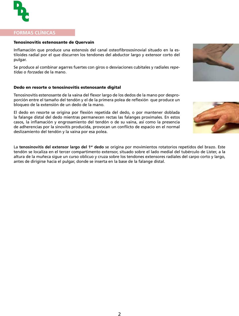 Dedo en resorte o tenosinovitis estenosante digital Tenosinovitis estenosante de la vaina del flexor largo de los dedos de la mano por desproporción entre el tamaño del tendón y el de la primera