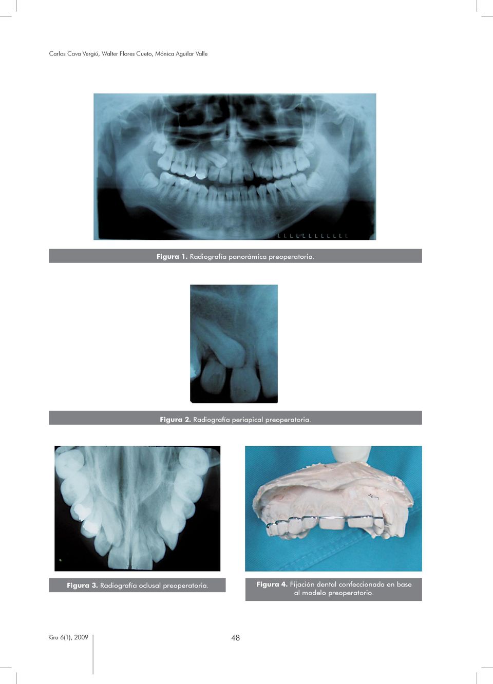 Radiografía periapical preoperatoria. Figura 4.