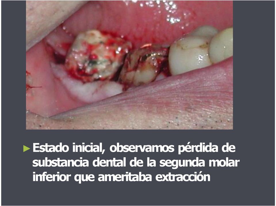 dental de la segunda molar