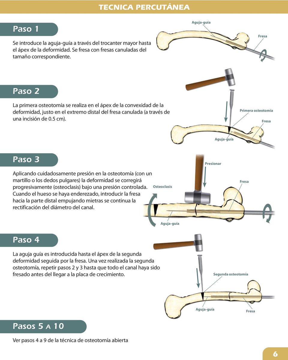Primera osteotomía Fresa Aguja-guía Paso 3 Presionar Aplicando cuidadosamente presión en la osteotomía (con un martillo o los dedos pulgares) la deformidad se corregirá progresivamente (osteoclasis)