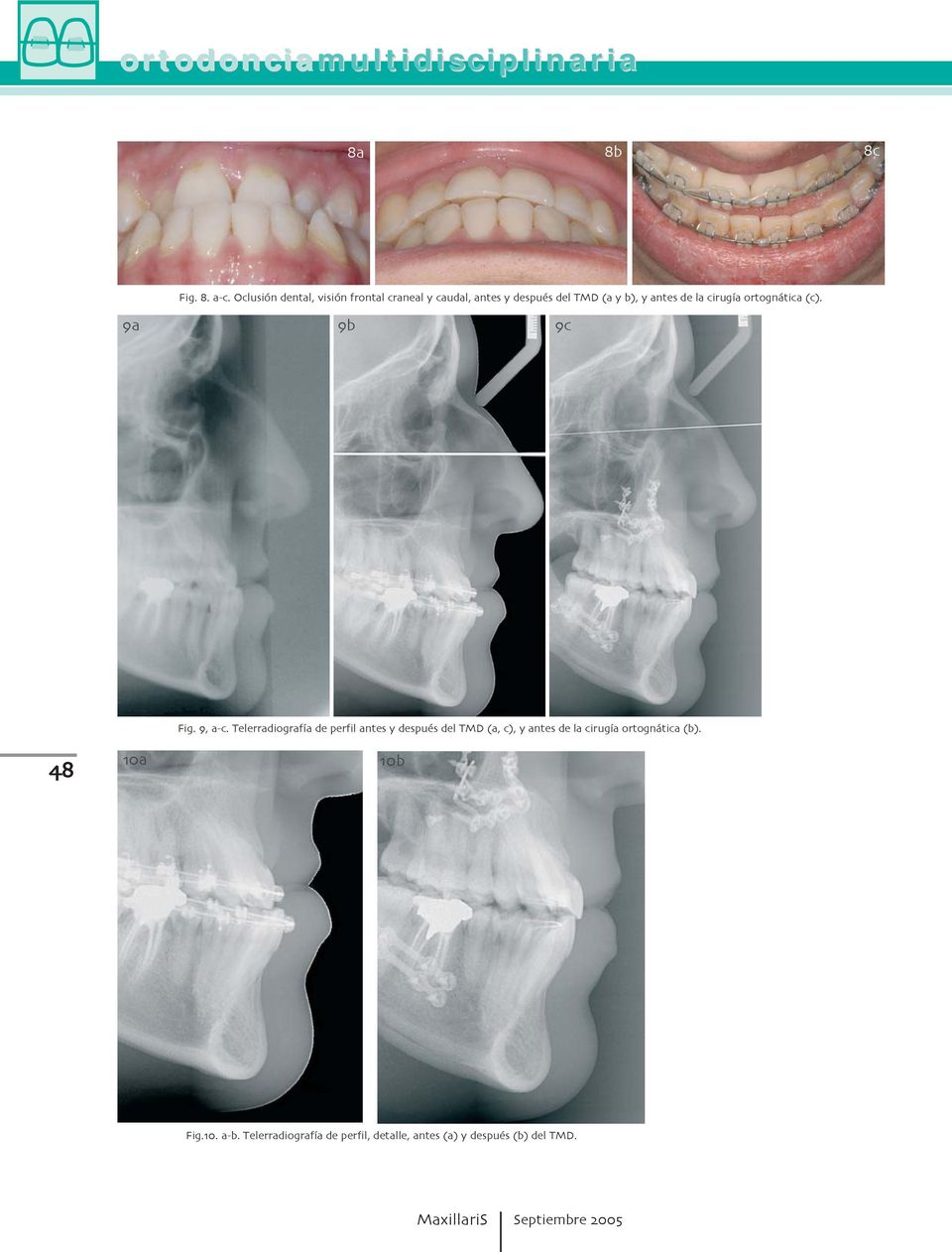 de perfil antes y después del TMD (a c) y antes de la cirugía ortognática