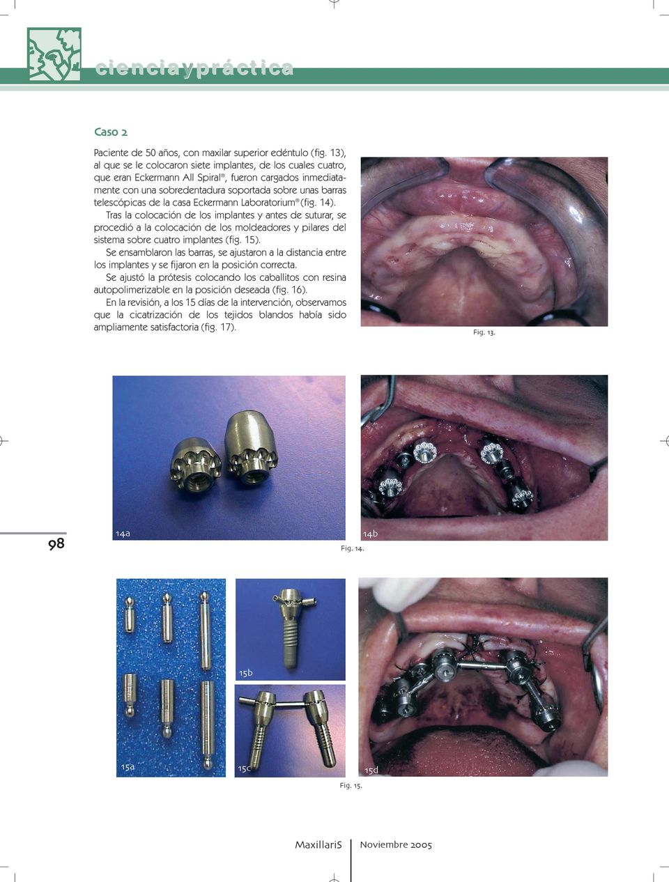 casa Eckermann Laboratorium (fig. 14). Tras la colocación de los implantes y antes de suturar, se procedió a la colocación de los moldeadores y pilares del sistema sobre cuatro implantes (fig. 15).