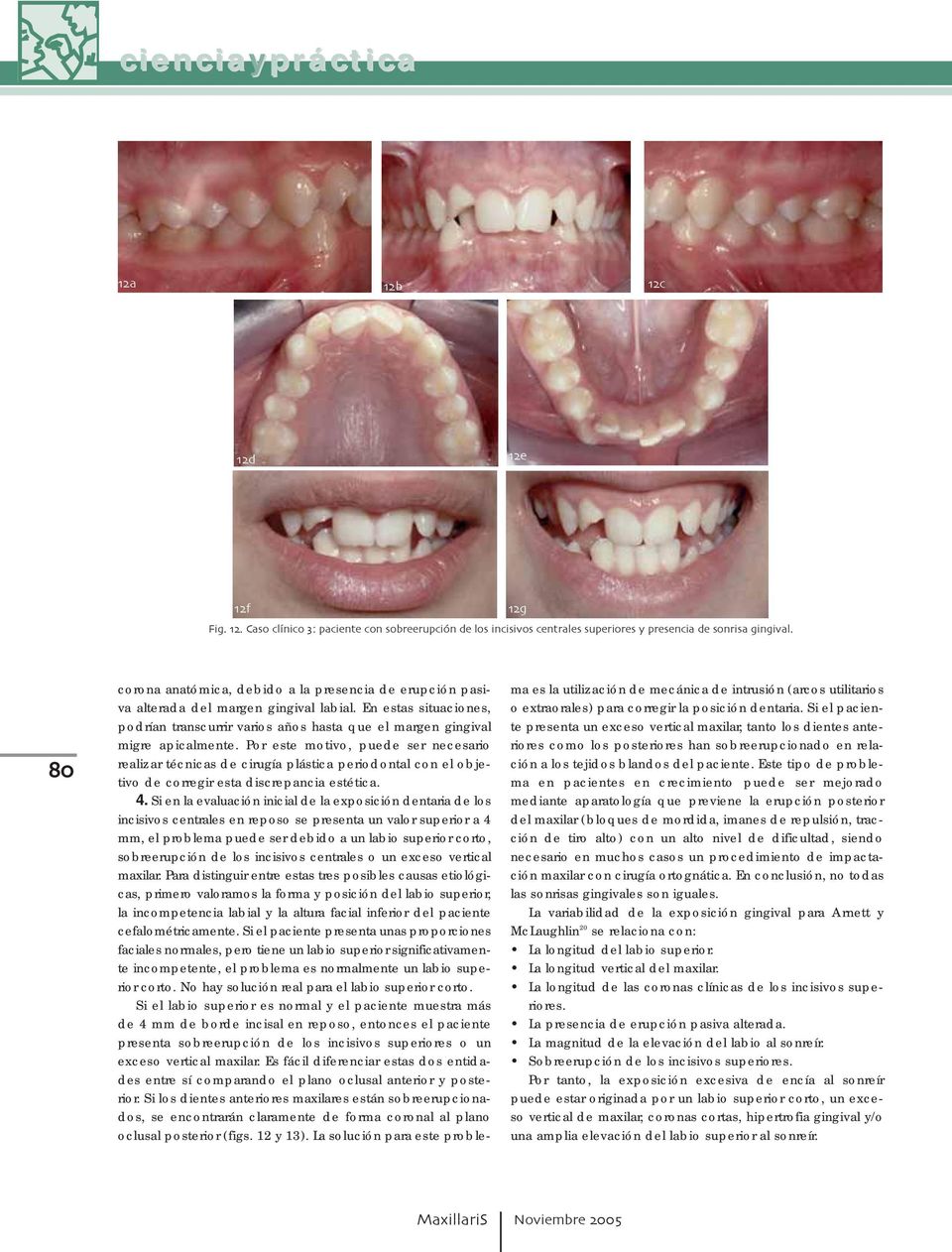 Por este motivo, puede ser necesario realizar técnicas de cirugía plástica periodontal con el objetivo de corregir esta discrepancia estética. 4.