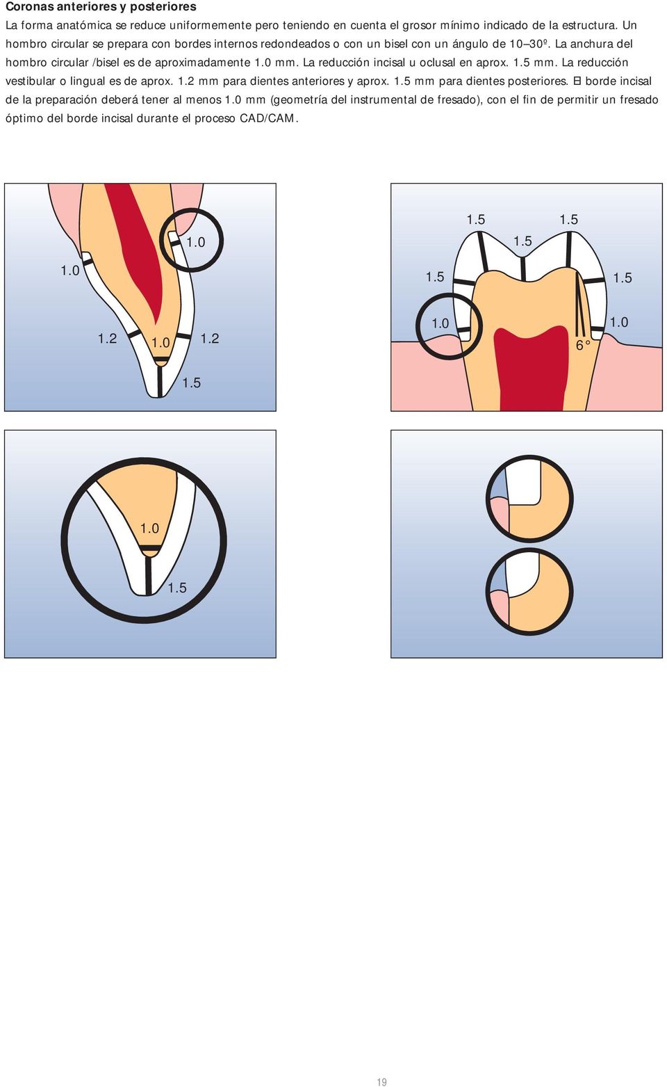 La reducción incisal u oclusal en aprox. 1.5 mm. La reducción vestibular o lingual es de aprox. 1.2 mm para dientes anteriores y aprox. 1.5 mm para dientes posteriores.
