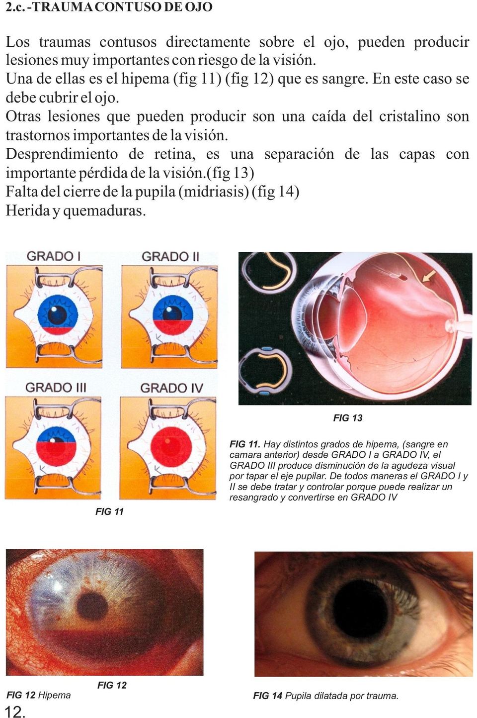 Desprendimiento de retina, es una separación de las capas con importante pérdida de la visión.(fig 13) Falta del cierre de la pupila (midriasis) (fig 14) Herida y quemaduras. FIG 13 FIG 11 FIG 11.