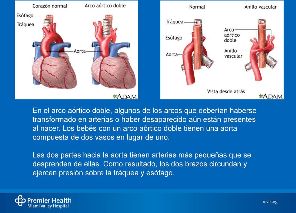 Los bebés con un arco aórtico doble tienen una aorta compuesta de dos vasos en lugar de uno.