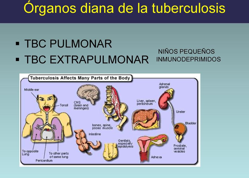 PULMONAR TBC