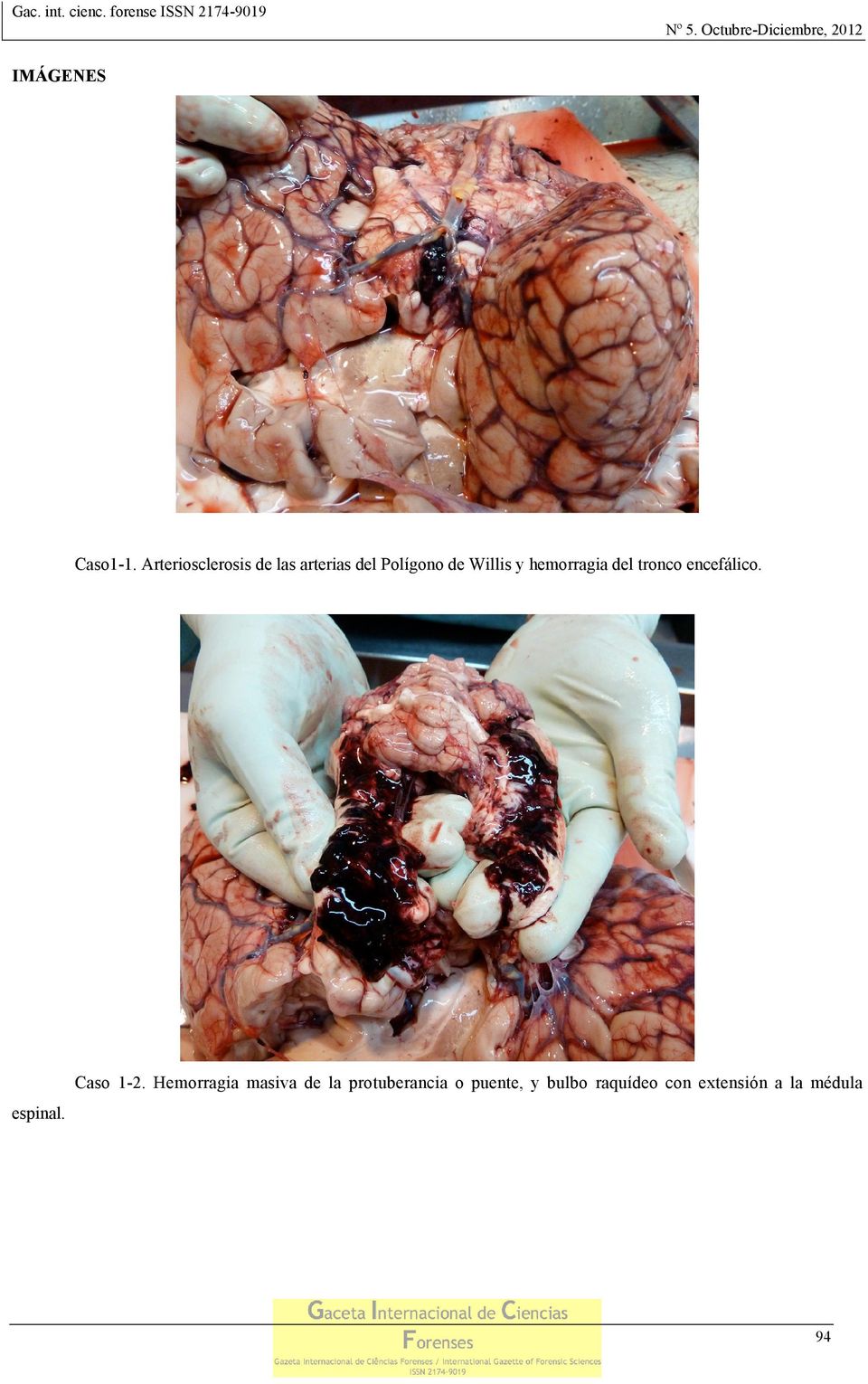 hemorragia del tronco encefálico. Caso 1-2.