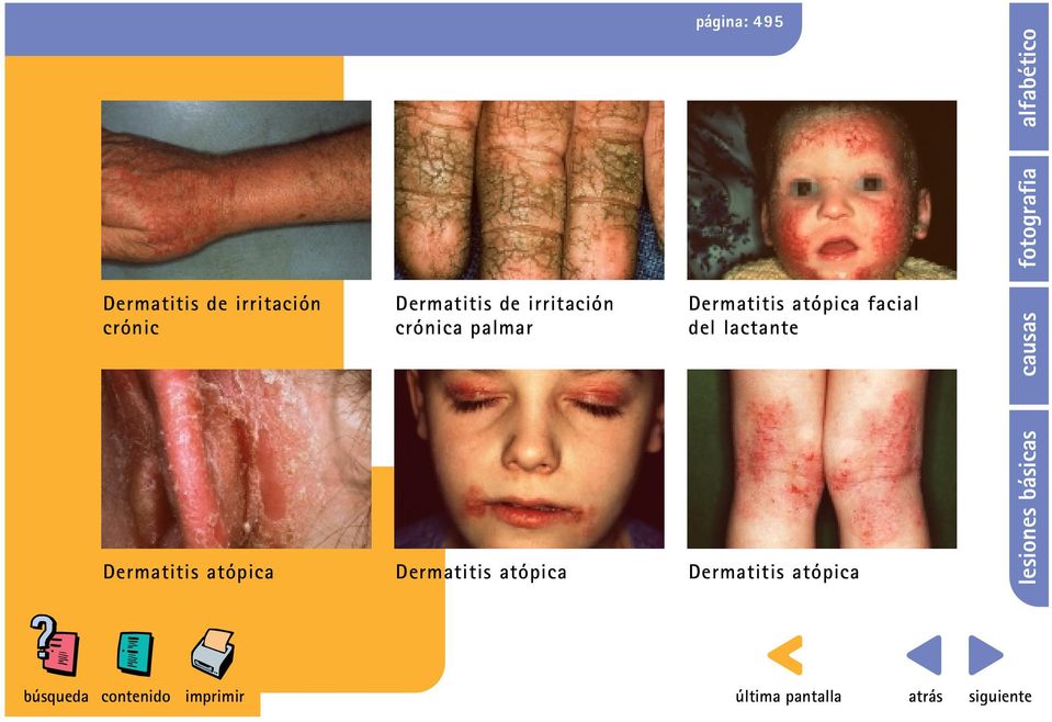 Dermatitis atópica facial del lactante