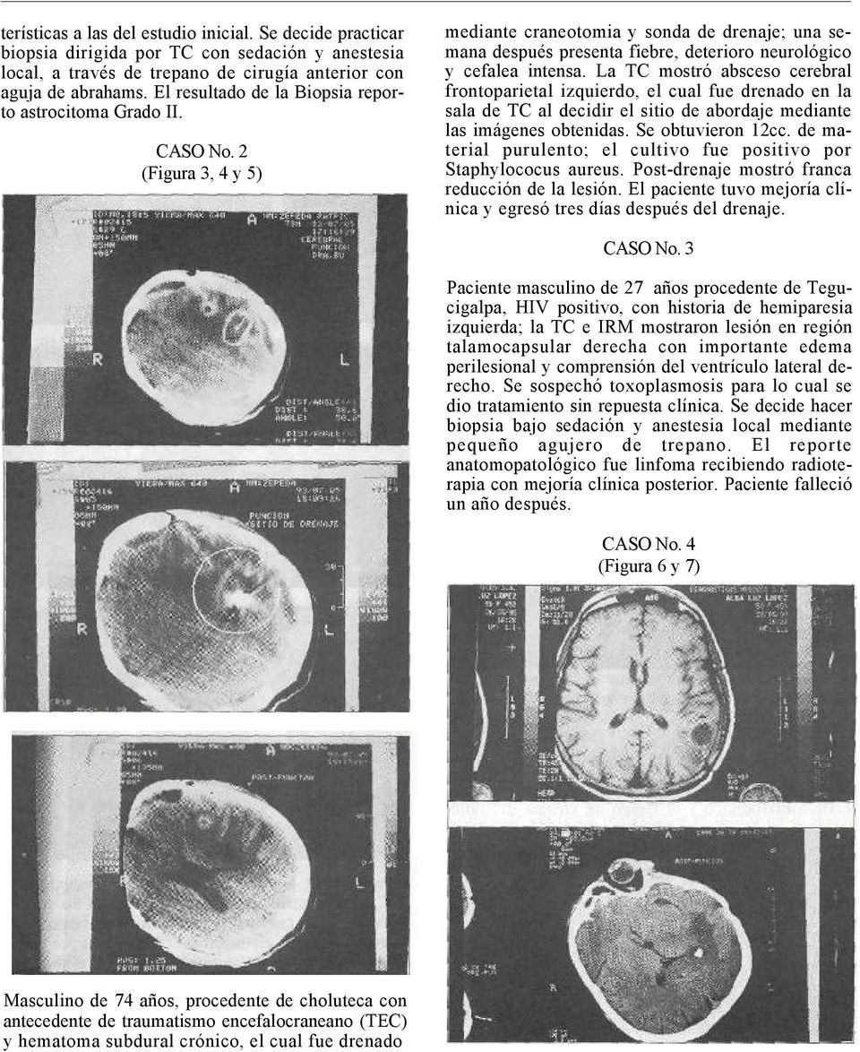 2 (Figura 3, 4 y 5) mediante craneotomia y sonda de drenaje; una semana después presenta fiebre, deterioro neurológico y cefalea intensa.