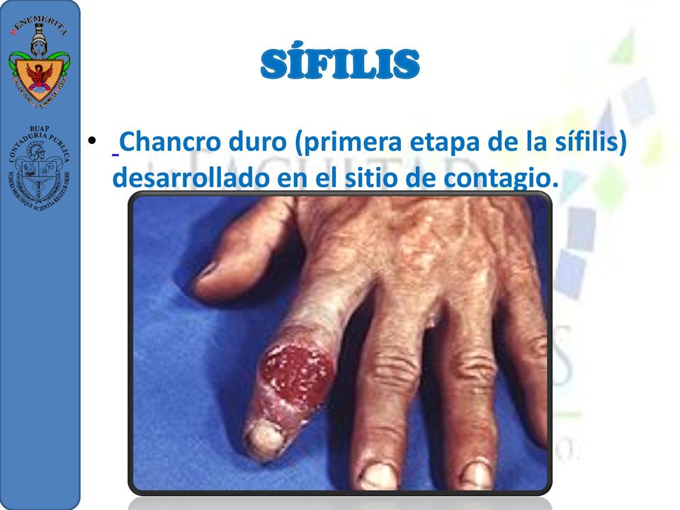 sífilis) desarrollado