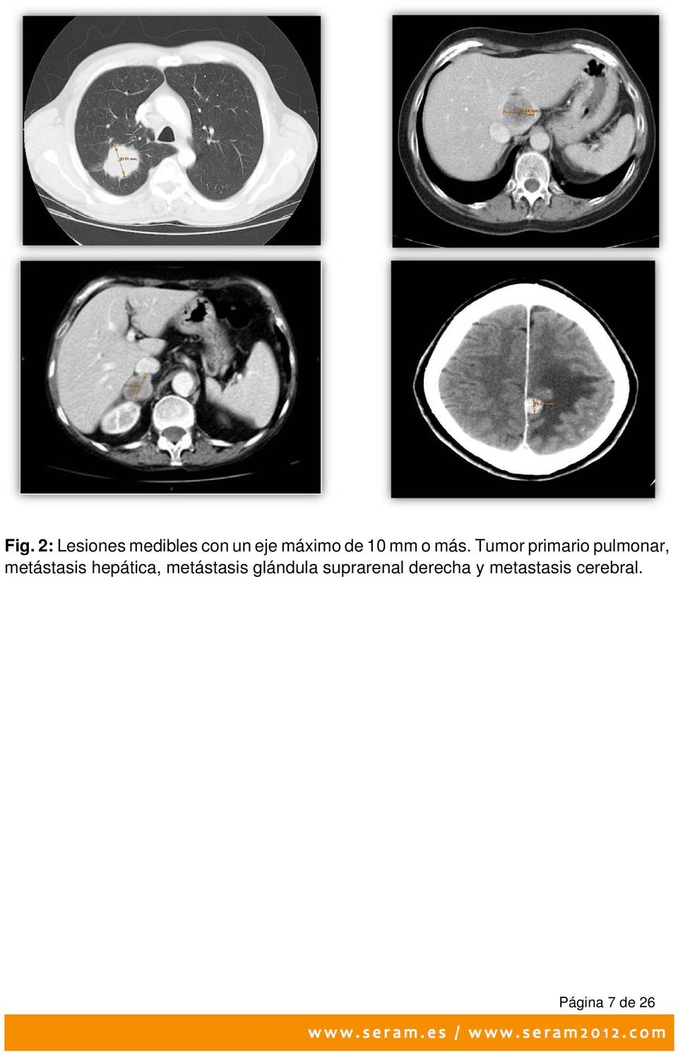 Tumor primario pulmonar, metástasis hepática,
