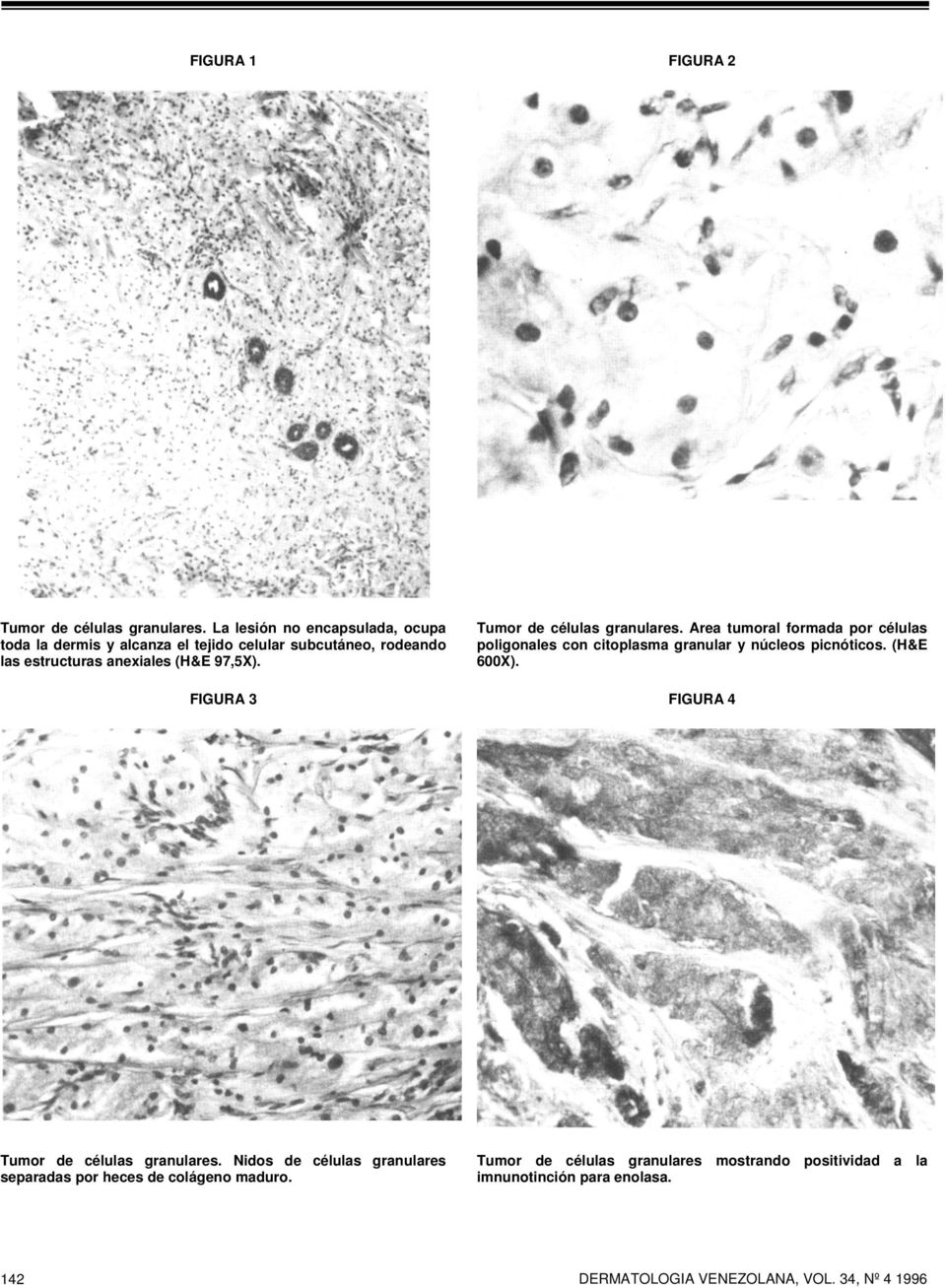 Tumor de células granulares. Area tumoral formada por células poligonales con citoplasma granular y núcleos picnóticos. (H&E 600X).