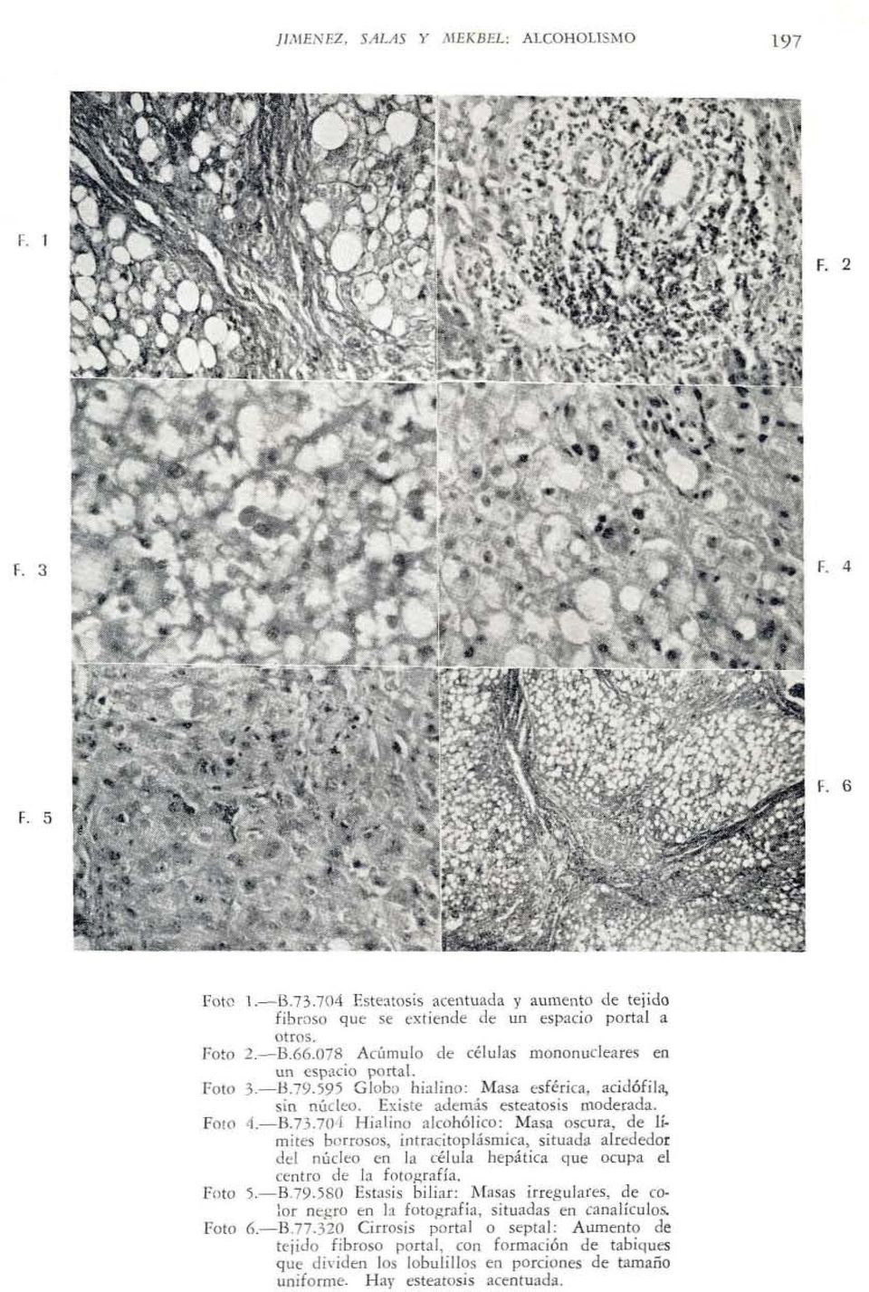 7Wl Hialino alcohólico: Masa oscura, de límites borrosos, intracitoplásmica, situada alrededor del núcleo en la célula hepática que ocupa el centro de la fotografía. Foto 5.-B79.