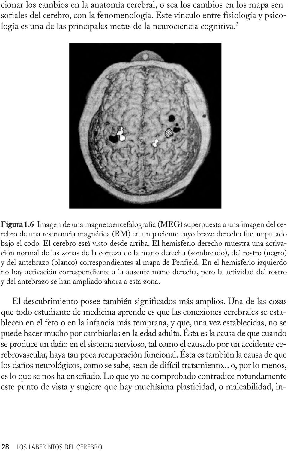 6 Imagen de una magnetoencefalografía (MEG) superpuesta a una imagen del cerebro de una resonancia magnética (RM) en un paciente cuyo brazo derecho fue amputado bajo el codo.