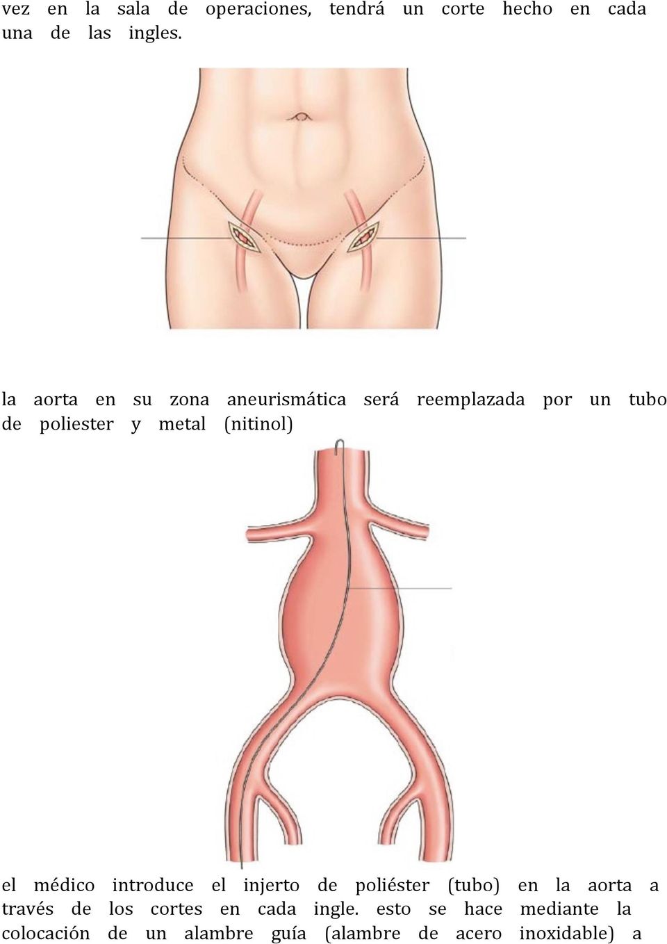 (nitinol) el médico introduce el injerto de poliéster (tubo) en la aorta a través de los