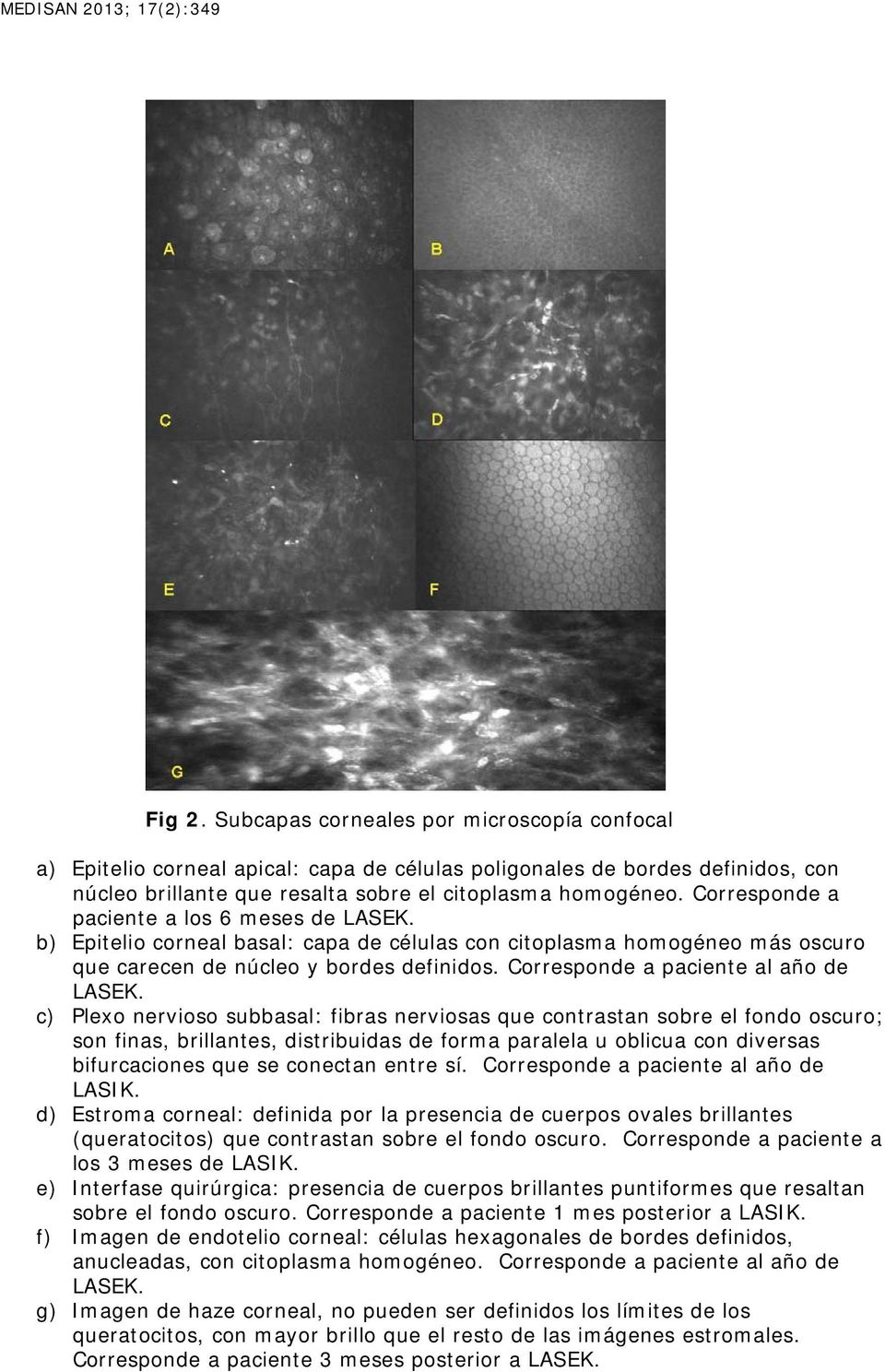 Corresponde a paciente a los 6 meses de LASEK. b) Epitelio corneal basal: capa de células con citoplasma homogéneo más oscuro que carecen de núcleo y bordes definidos.