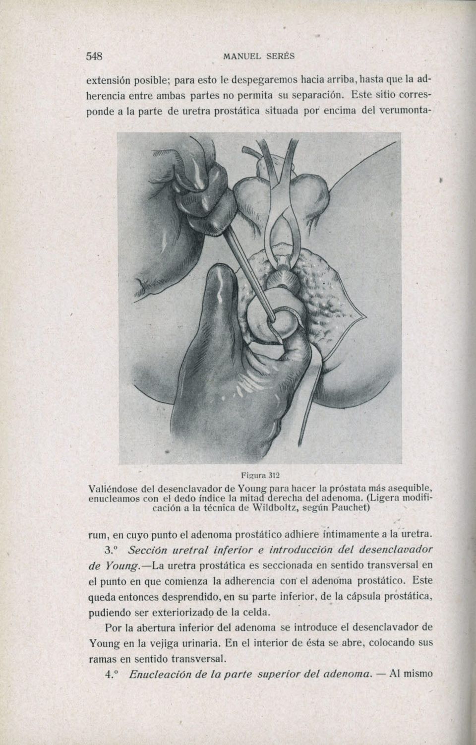 índice la mitad derecha del adenoma. (Ligera modifi cación a la técnica de Wildboltz, según Pauchet) rum, en cuyo punto el adenoma prostático adhiere íntimamente a la uretra. 3.
