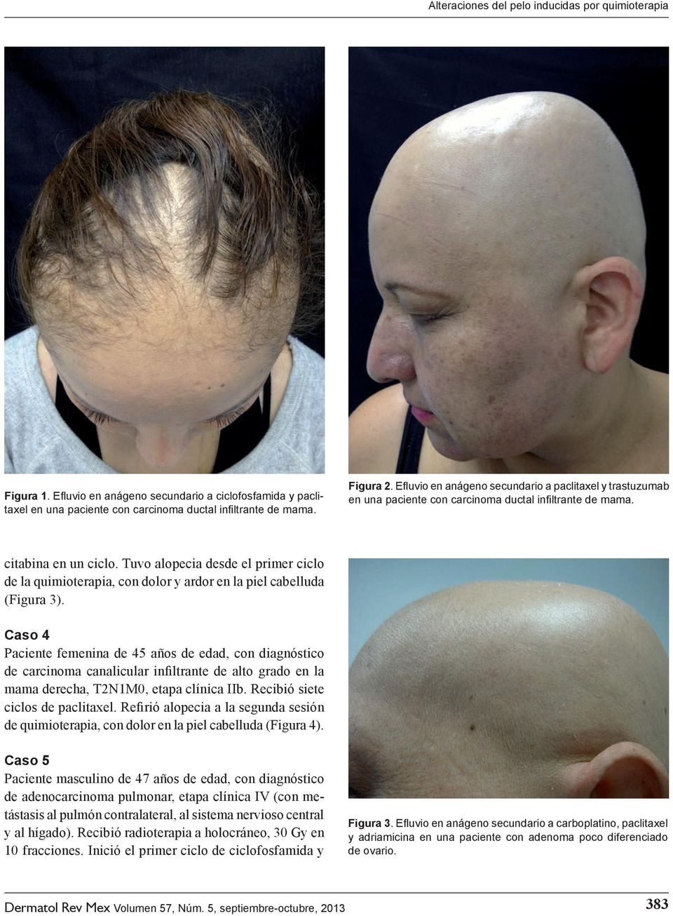 Tuvo alopecia desde el primer ciclo de la quimioterapia, con dolor y ardor en la piel cabelluda (Figura 3).