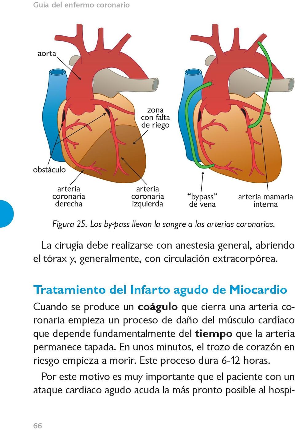Tratamiento del Infarto agudo de Miocardio Cuando se produce un coágulo que cierra una arteria coronaria empieza un proceso de daño del músculo cardíaco que