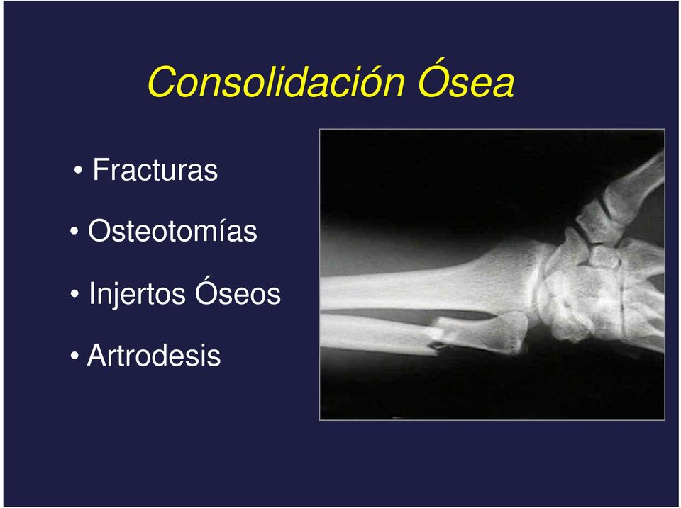 Osteotomías