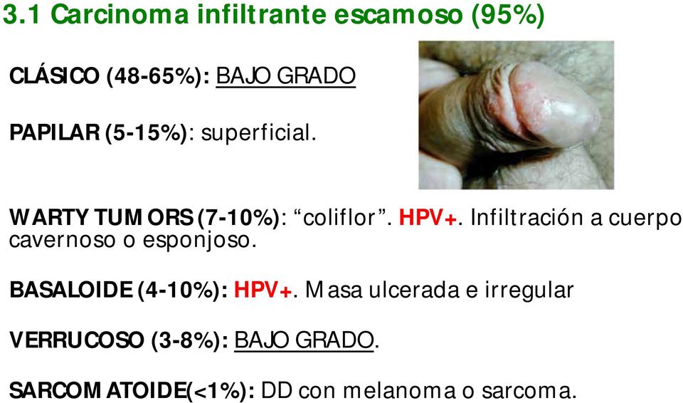 Infiltración a cuerpo cavernoso o esponjoso. BASALOIDE (4-10%): HPV+.