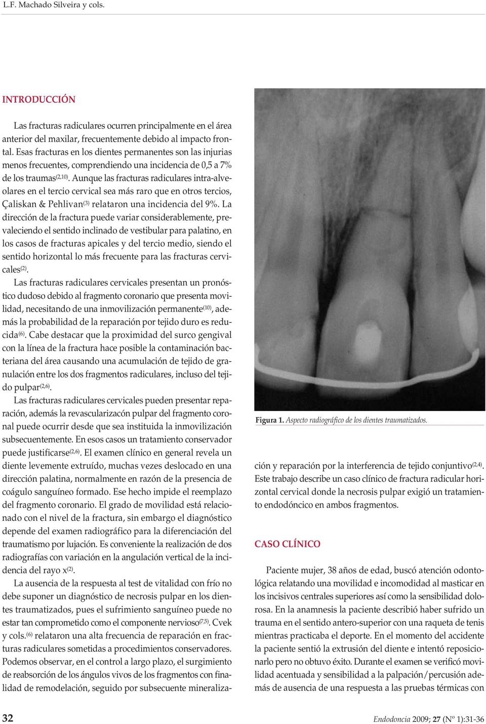 Esas fracturas en los dientes permanentes son las injurias menos frecuentes, comprendiendo una incidencia de 0,5 a 7% de los traumas (2,10).