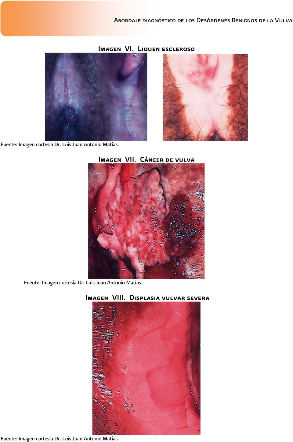 Cáncer de vulva Fuente: Imagen cortesía Dr.