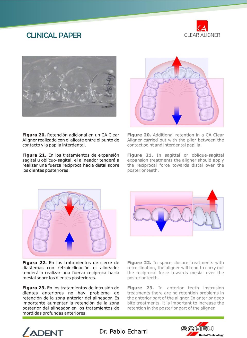 Additional retention in a CA Clear Aligner carried out with the plier between the contact point and interdental papilla. Figure 21.