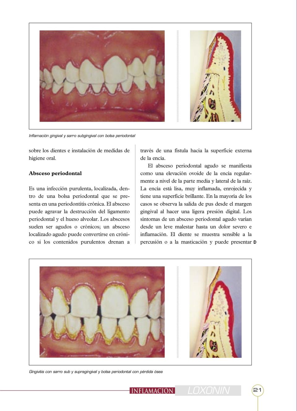 El absceso puede agravar la destrucción del ligamento periodontal y el hueso alveolar.