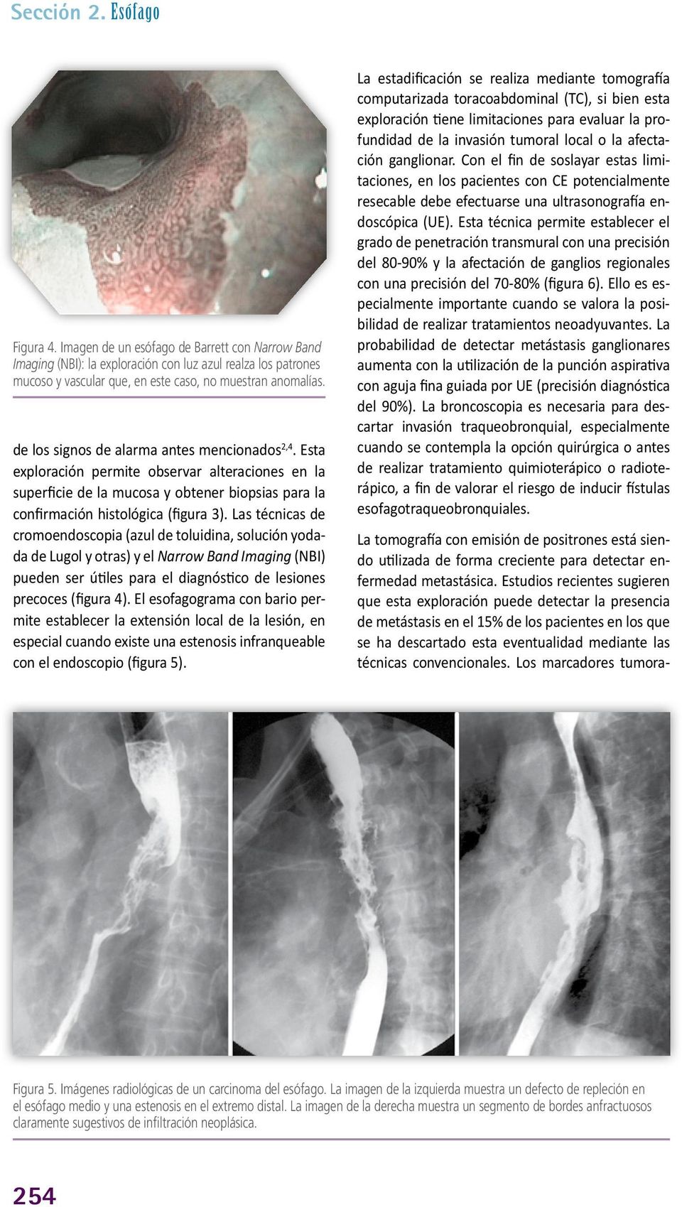 Las técnicas de cromoendoscopia (azul de toluidina, solución yodada de Lugol y otras) y el Narrow Band Imaging (NBI) pueden ser útiles para el diagnóstico de lesiones precoces (figura 4).
