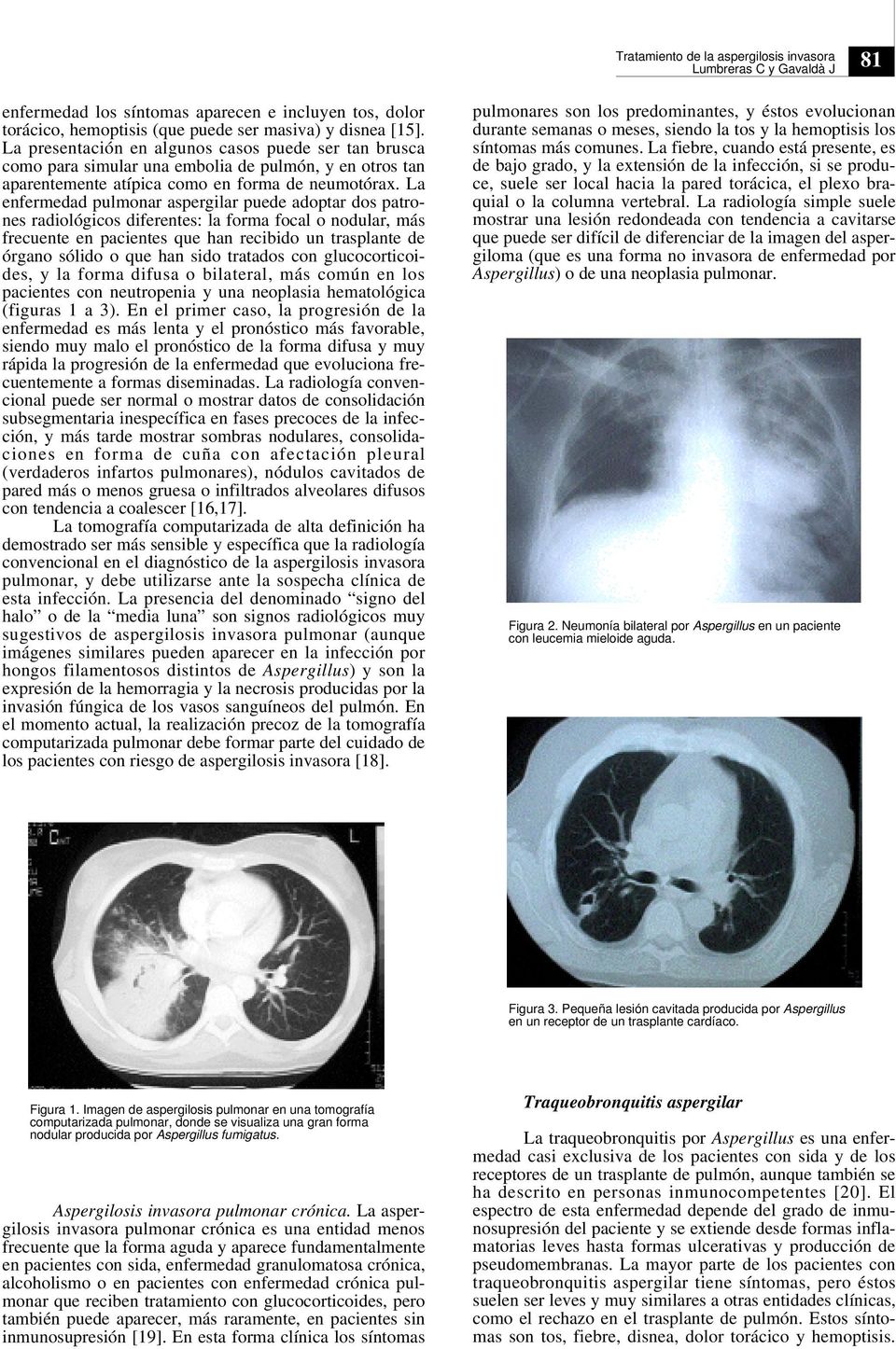 La enfermedad pulmonar aspergilar puede adoptar dos patrones radiológicos diferentes: la forma focal o nodular, más frecuente en pacientes que han recibido un trasplante de órgano sólido o que han