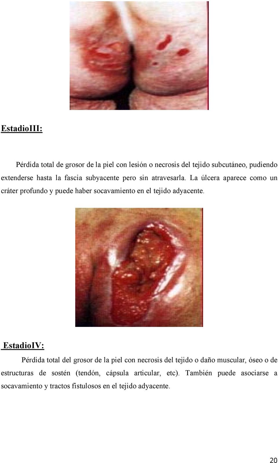 La úlcera aparece como un cráter profundo y puede haber socavamiento en el tejido adyacente.