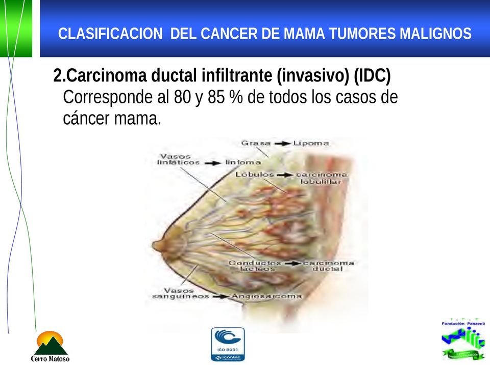 Carcinoma ductal infiltrante (invasivo)
