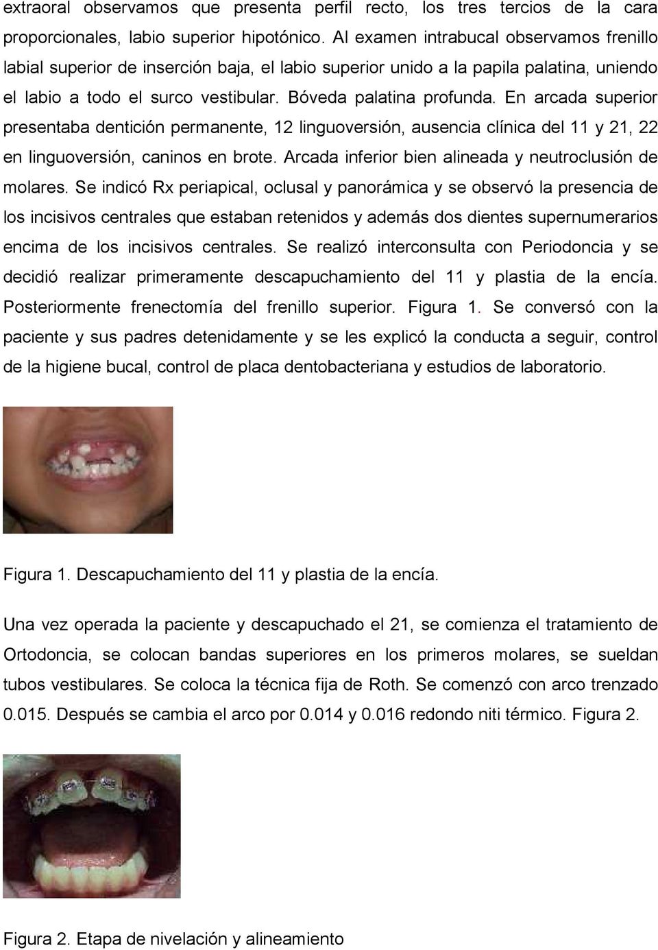 En arcada superior presentaba dentición permanente, 12 linguoversión, ausencia clínica del 11 y 21, 22 en linguoversión, caninos en brote. Arcada inferior bien alineada y neutroclusión de molares.