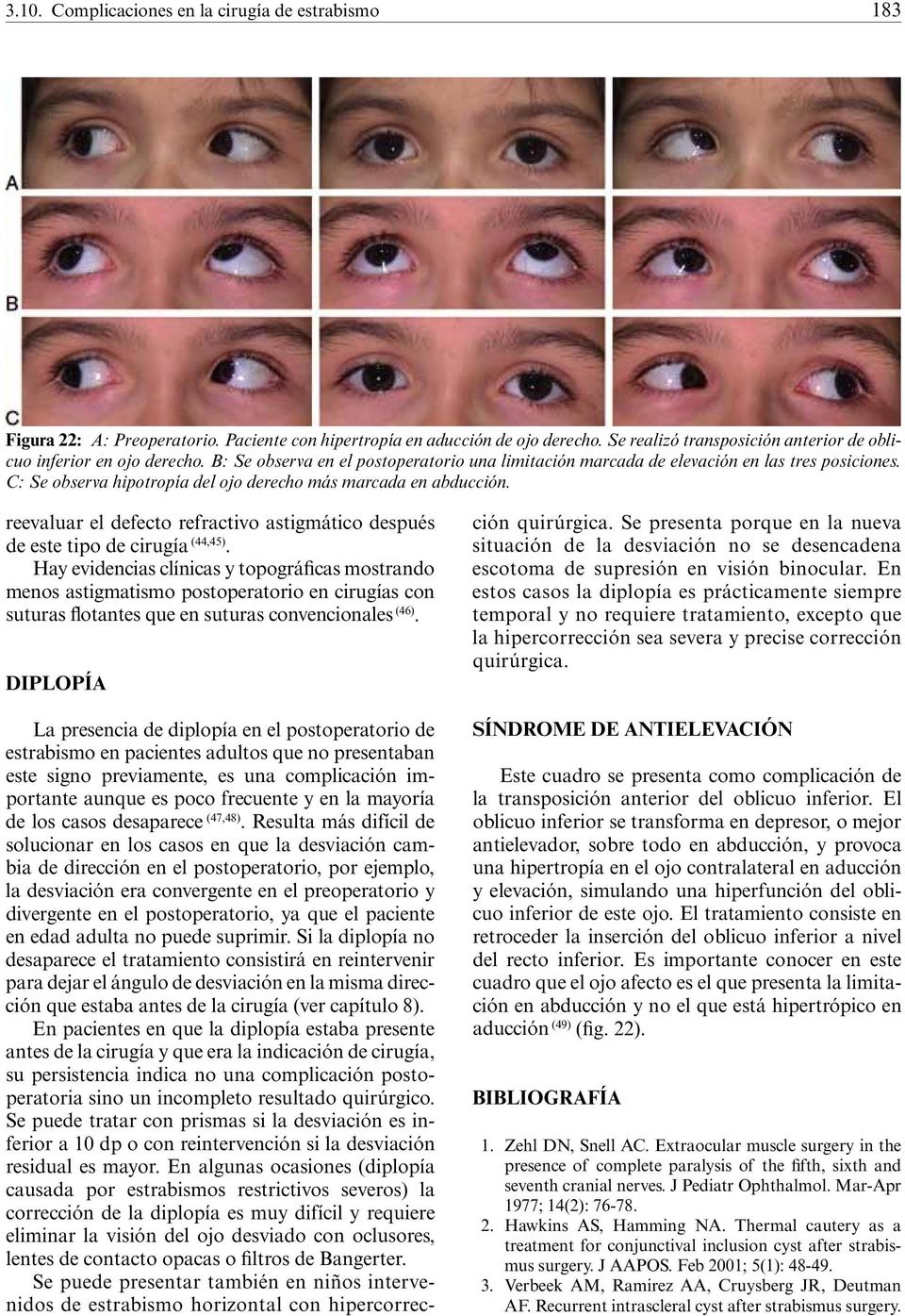 C: Se observa hipotropía del ojo derecho más marcada en abducción. reevaluar el defecto refractivo astigmático después de este tipo de cirugía (44,45).
