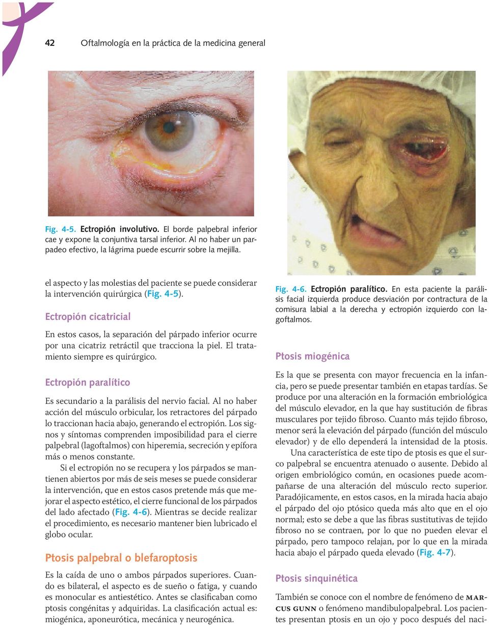 Los pacientes presentan ptosis en un ojo y poco después del naciel aspecto y las molestias del paciente se puede considerar la intervención quirúrgica (Fig. 4-5).