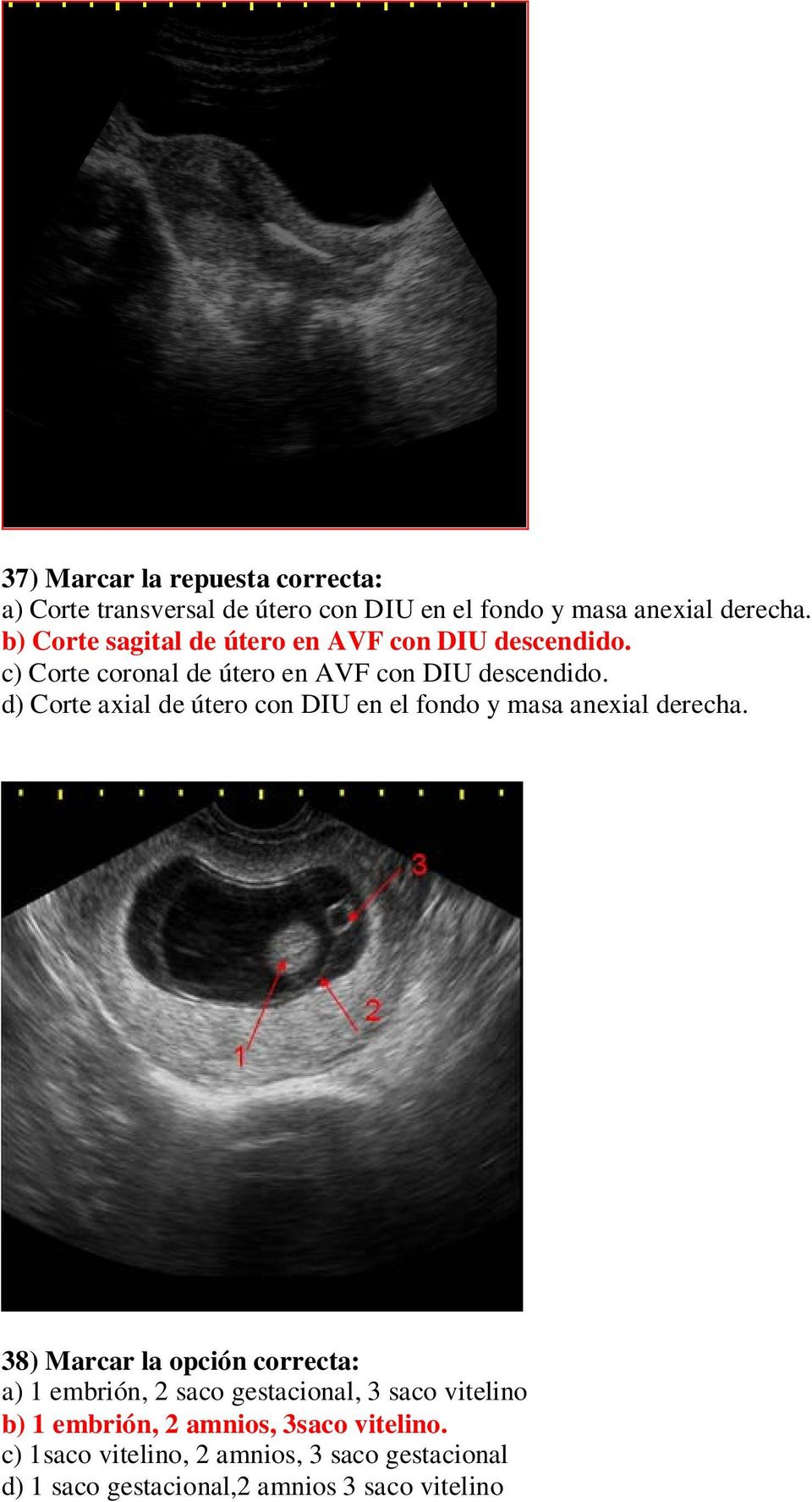 d) Corte axial de útero con DIU en el fondo y masa anexial derecha.