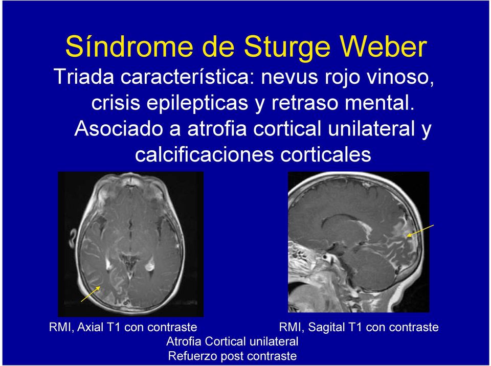 Asociado a atrofia cortical unilateral y calcificaciones corticales