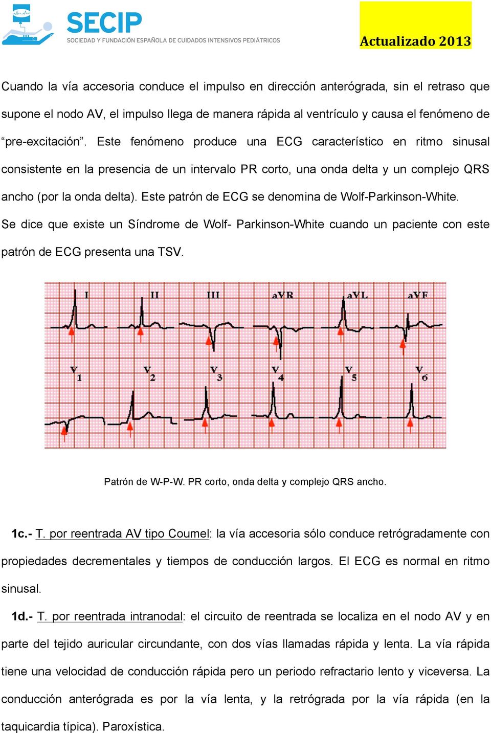 Este patrón de ECG se denomina de Wolf-Parkinson-White. Se dice que existe un Síndrome de Wolf- Parkinson-White cuando un paciente con este patrón de ECG presenta una TSV. Patrón de W-P-W.