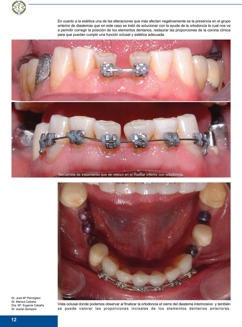 para que puedan cumplir una función oclusal y estética adecuada. Secuencia de tratamiento que se realizó en el maxilar inferior con ortodoncia.