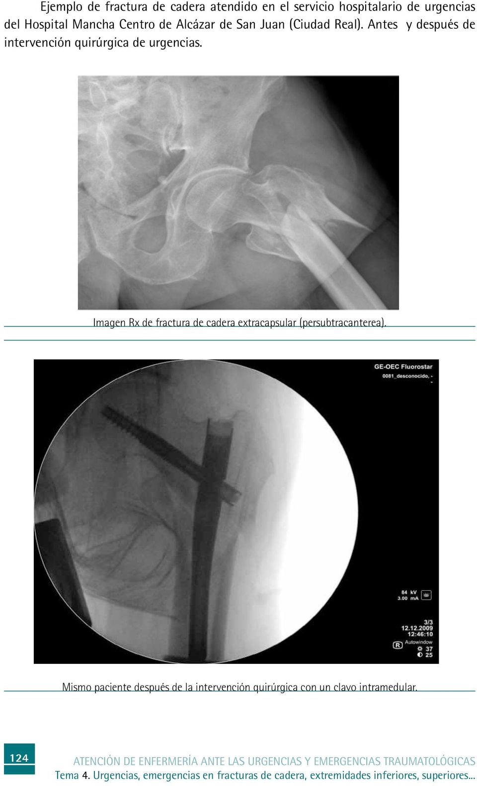 Imagen Rx de fractura de cadera extracapsular (persubtracanterea).