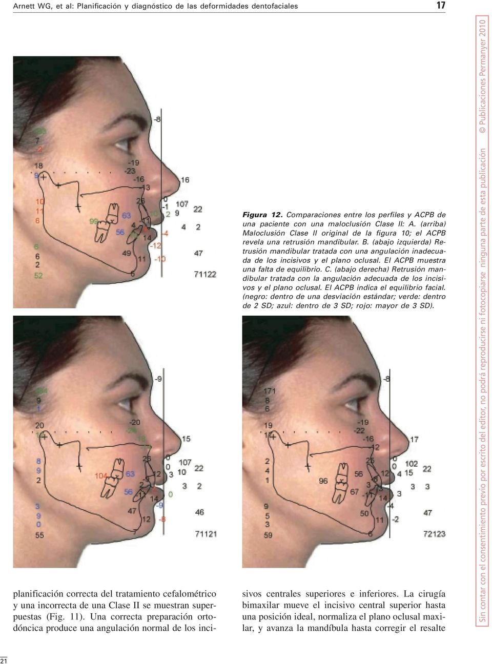 (abajo derecha) Retrusión mandibular tratada con la angulación adecuada de los incisivos y el plano oclusal. El ACPB indica el equilibrio facial.