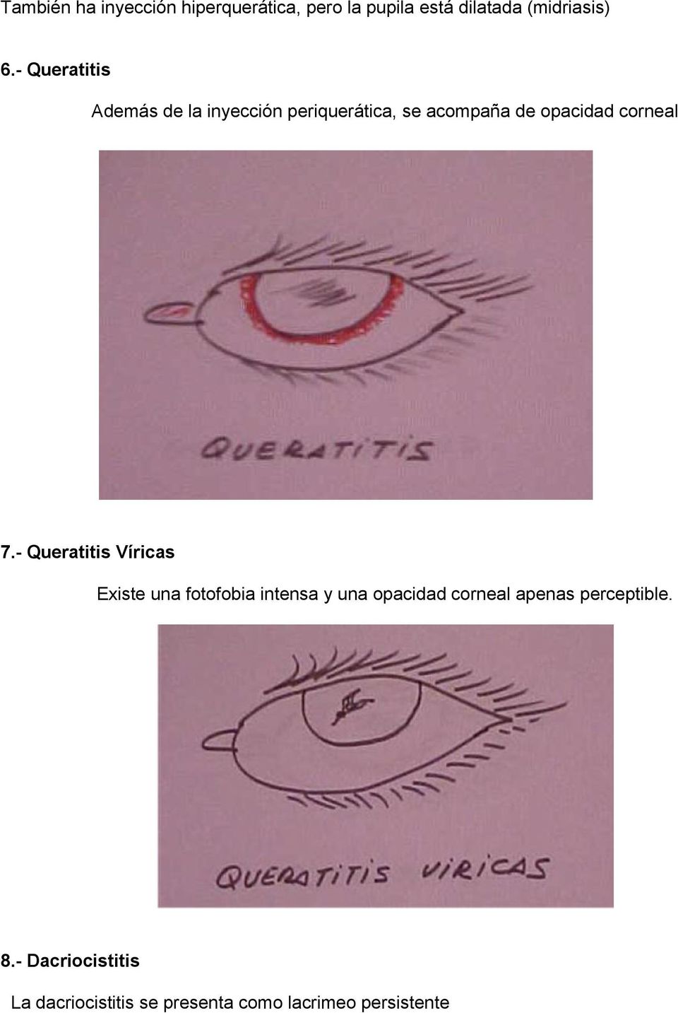 7.- Queratitis Víricas Existe una fotofobia intensa y una opacidad corneal apenas