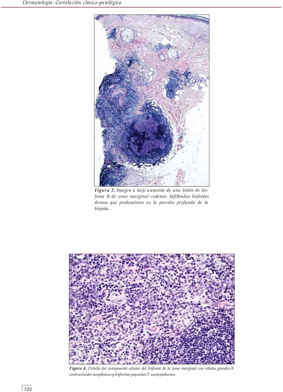 Infiltrados linfoides densos que predominan en la porción profunda de la biopsia. Figura 4.