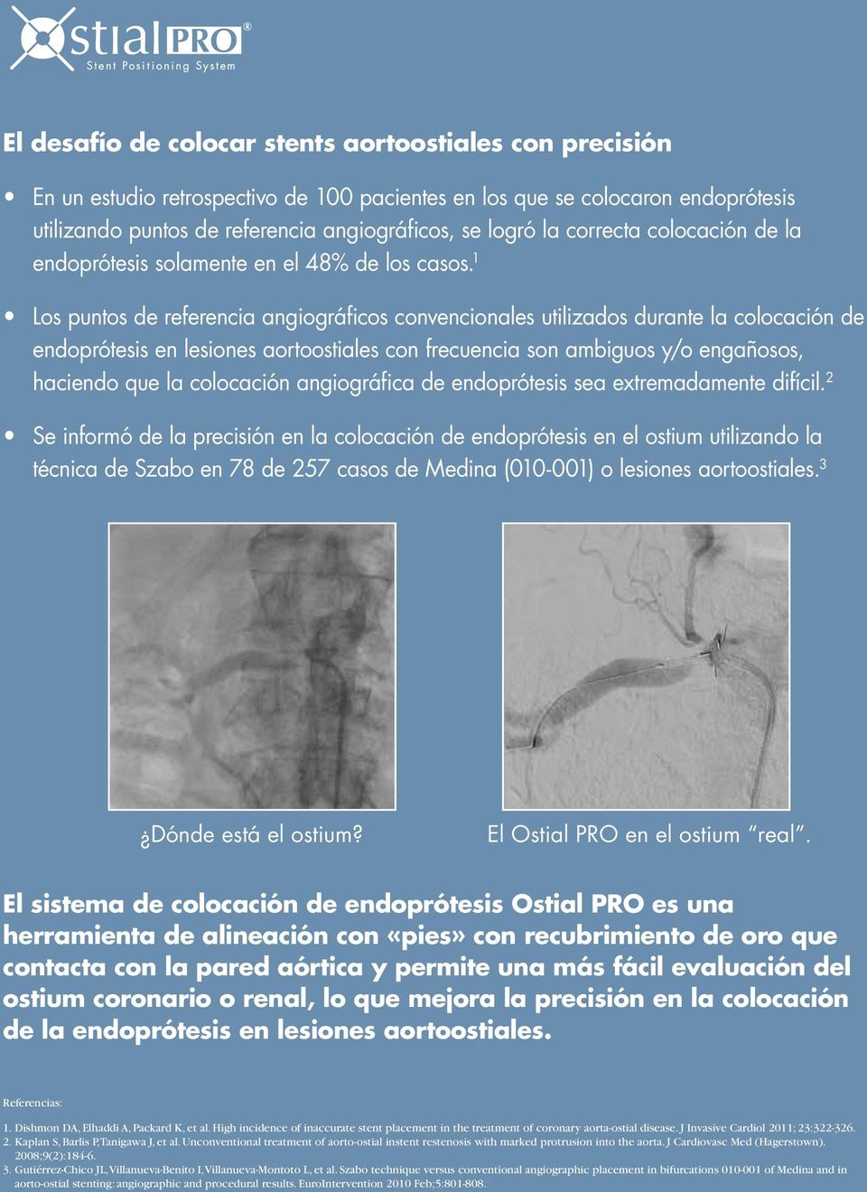 1 Los puntos de referencia angiográficos convencionales utilizados durante la colocación de endoprótesis en lesiones aortoostiales con frecuencia son ambiguos y/o engañosos, haciendo que la